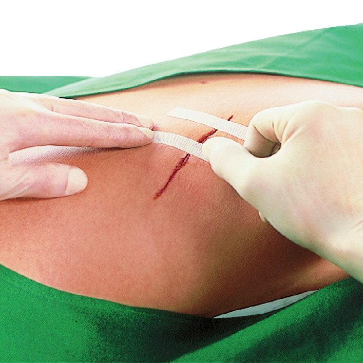 Leukostrip Wundnahtstreifen, Sterifenpflaster, Pflaster, Wundpflaster, Nahtstreifen