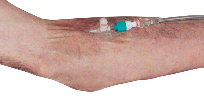 RUDAVEN®-transparent, Kanülenfixierpflaster, Kanülenpflaster