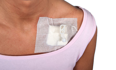 Portkanülen Set, Portzugangs-Set